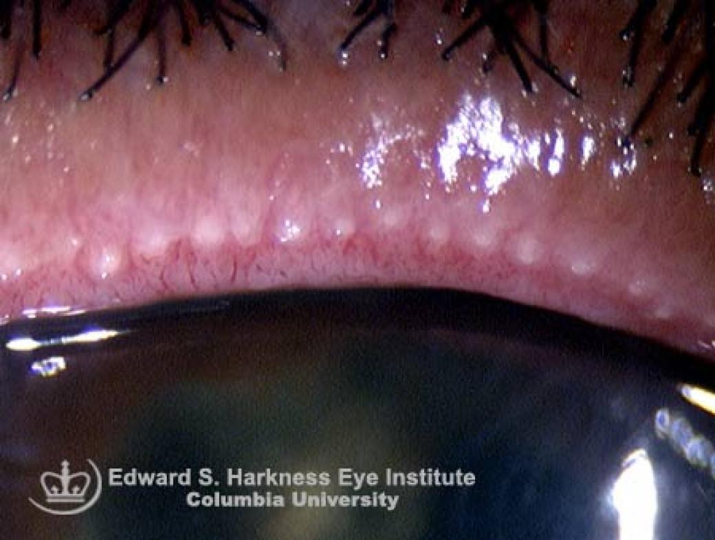 Stenosed Glands In Meibomian Gland Dysfunction Vagelos College Of Physicians And Surgeons 