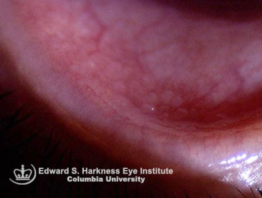 Follicular Conjunctivitis Vagelos College Of Physicians And Surgeons 