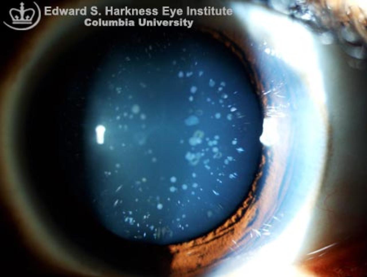 Blue Dot Cataract | Vagelos College of Physicians and Surgeons