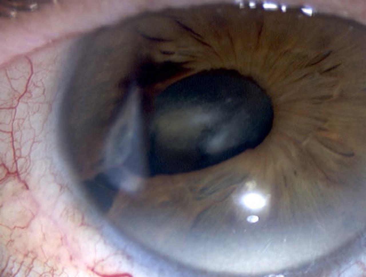 Iris Coloboma | Vagelos College of Physicians and Surgeons