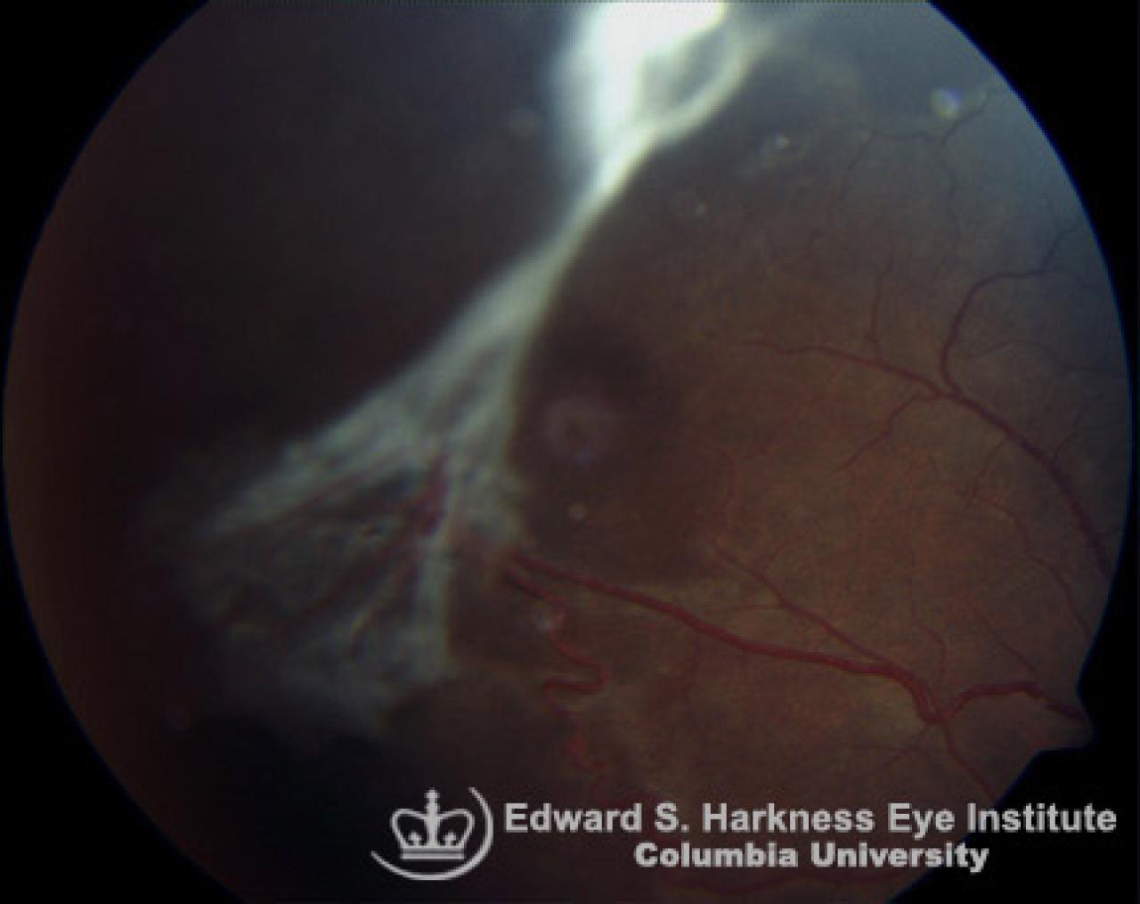 Sickle Cell Proliferative Retinopathy Vagelos College Of Physicians   Sickle Cell Proliferative Retinopathy 