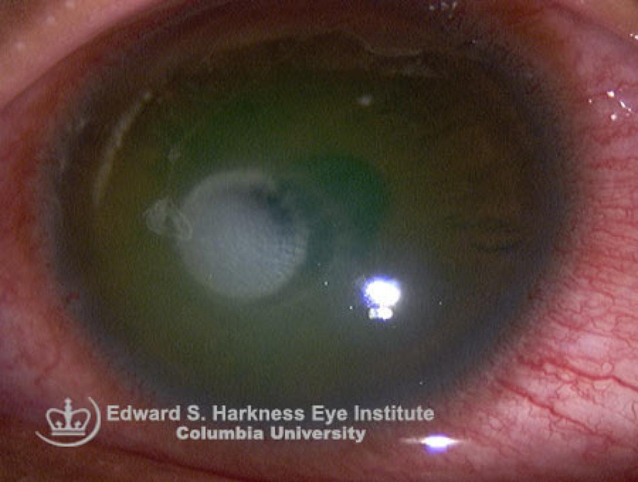 Acanthamoeba Keratitis Vagelos College Of Physicians And Surgeons 0100