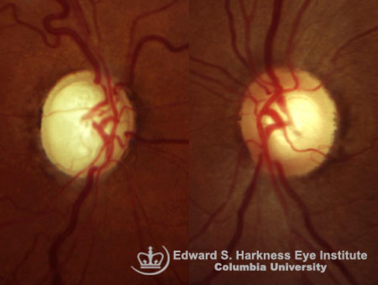 Glaucomatous Optic Nerve Vagelos College Of Physicians And Surgeons