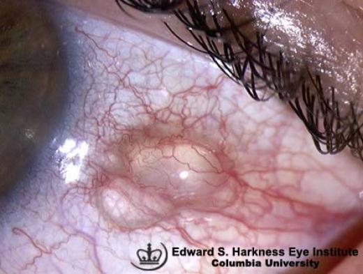 Conjunctival Cyst Vagelos College Of Physicians And Surgeons 4600