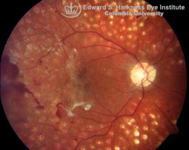 Panretinal Photocoagulation | Vagelos College Of Physicians And Surgeons