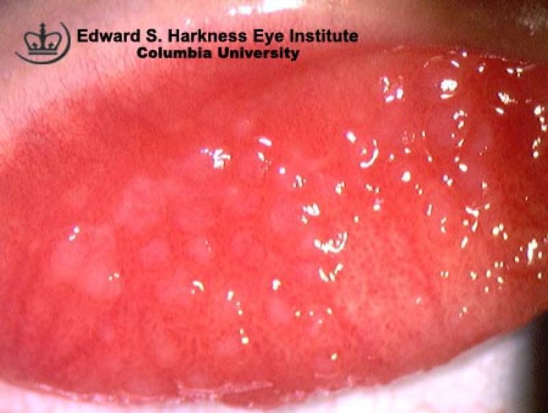 Giant Papillary Conjunctivitis Vagelos College Of Physicians And Surgeons